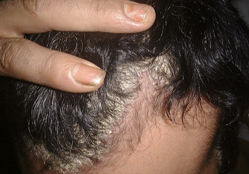 psoriasis cheveux contagieux