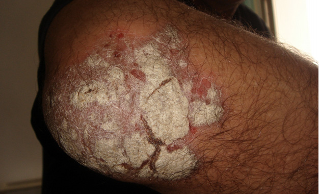 Psoriasis