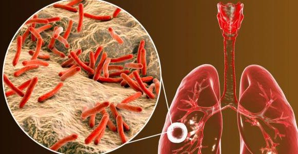 ملتقى علمي بأريانة تحت شعار: مالجديد في مرض السل لسنة 2026؟