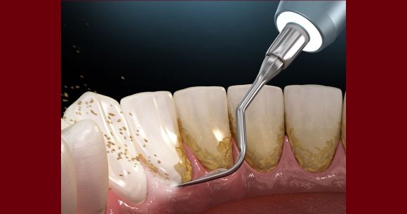 اشهار عروض على الإنترنت لتبييض الأسنان بطرق عشوائية، وزارة الصحة تحذر…