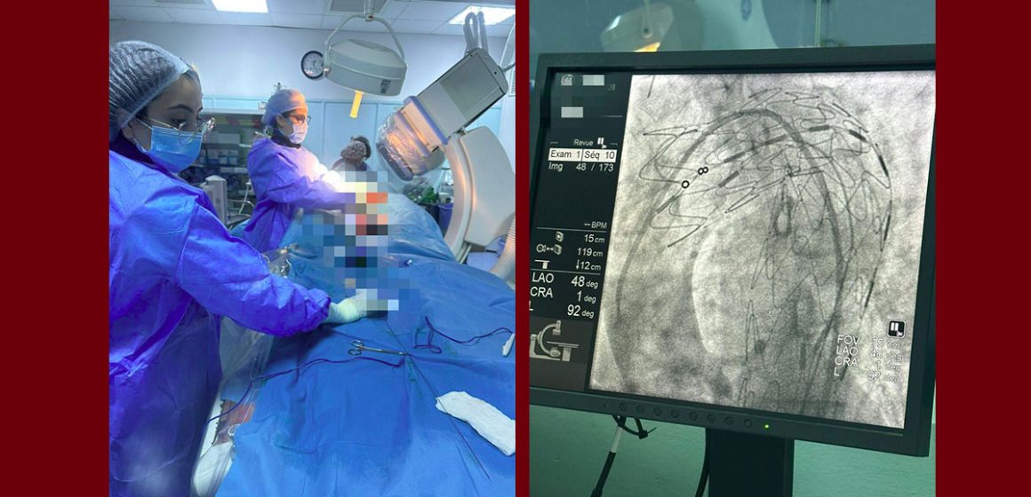 منزل بورقيبة: نجاح أول عملية لتركيب دعامة للأبهر الصدري النازل Endoprothèse) aortique)