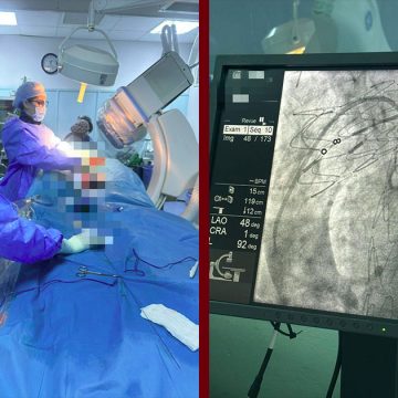 منزل بورقيبة: نجاح أول عملية لتركيب دعامة للأبهر الصدري النازل Endoprothèse) aortique)