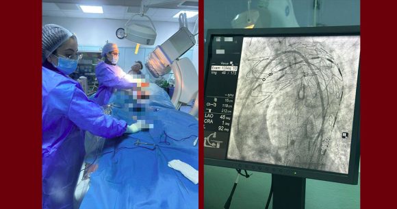 منزل بورقيبة: نجاح أول عملية لتركيب دعامة للأبهر الصدري النازل Endoprothèse) aortique)