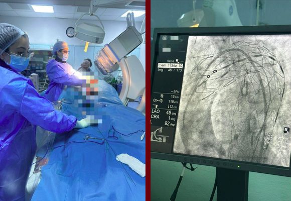 منزل بورقيبة: نجاح أول عملية لتركيب دعامة للأبهر الصدري النازل Endoprothèse) aortique)