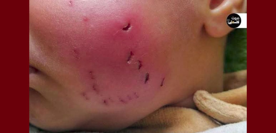 الأوضاع البيئية و الصحية في قطاع غزة: تفشي الأوبئة نتيجة انتشار القوارض