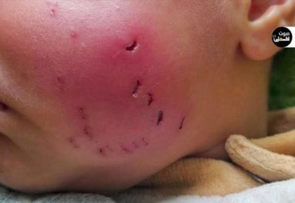 الأوضاع البيئية و الصحية في قطاع غزة: تفشي الأوبئة نتيجة انتشار القوارض