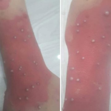 Sfax – Patiente suspectée d’être infectée par la variole du singe : Les tests PCR montrent qu’elle souffre de varicelle