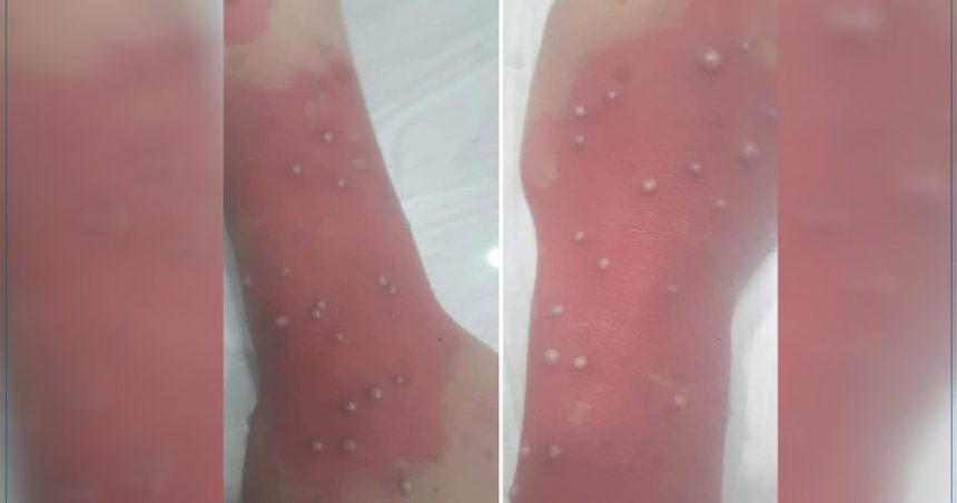 Patiente suspectée d’être infectée par la variole du singe : Les précisions de l’hôpital de Sfax