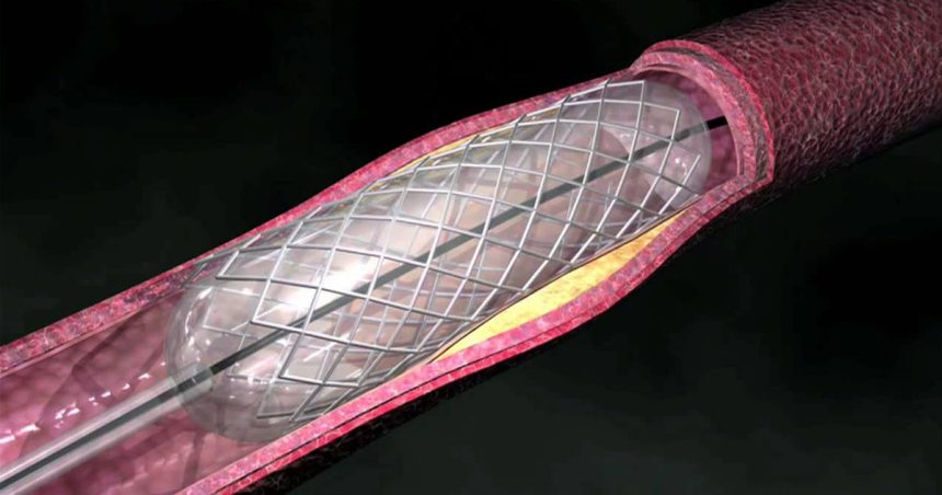 Les potins du cardiologue : la thrombose de stents, ou l’arbre qui peut cacher la montagne 