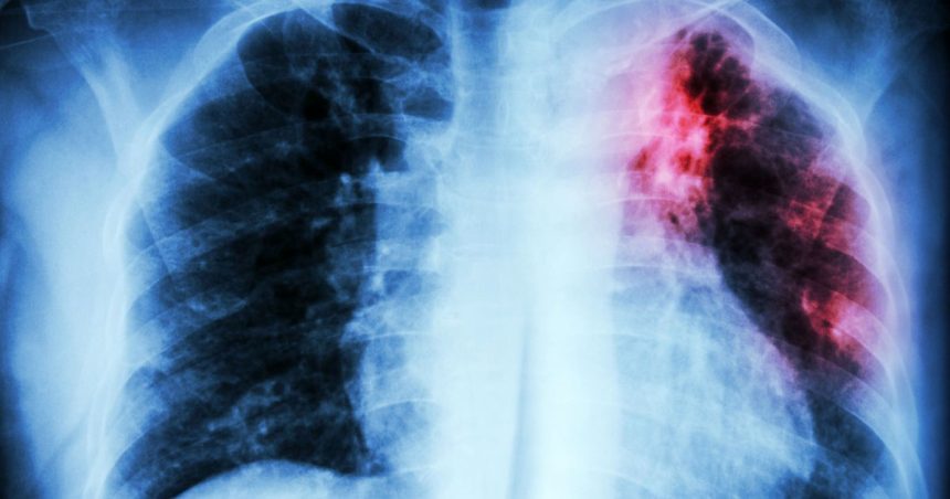 La Tunisie a enregistré 3 264 nouveaux cas de tuberculose en 2022