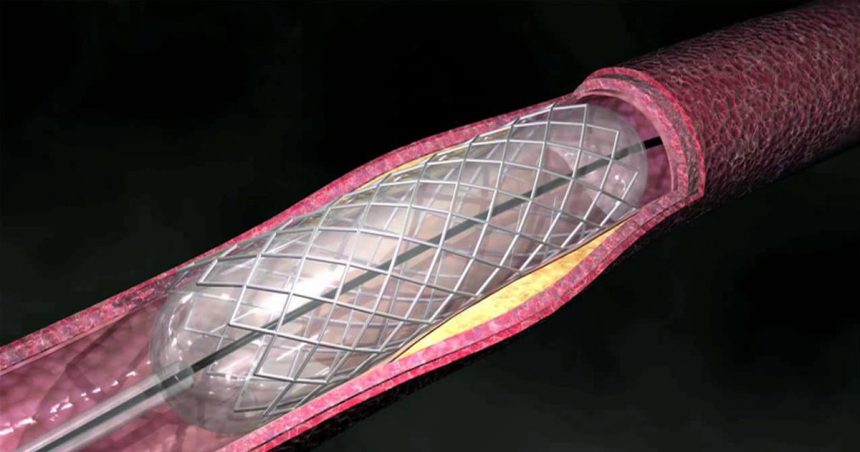 Les potins du cardiologue : un tronc commun et un praticien qui l’est peu