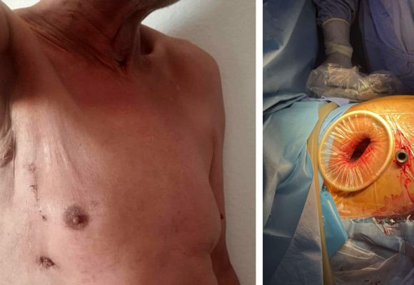 Première médicale en chirurgie cardiovasculaire à Sfax