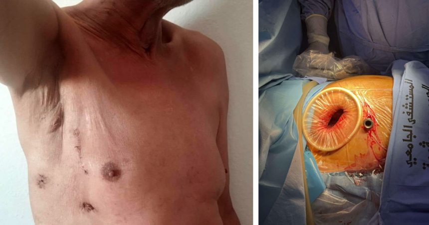 Première médicale en chirurgie cardiovasculaire à Sfax
