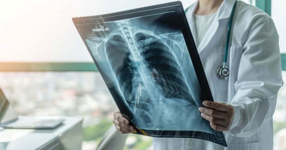 Tuberculose | Le vaccin ne garantit pas une immunité à 100 %