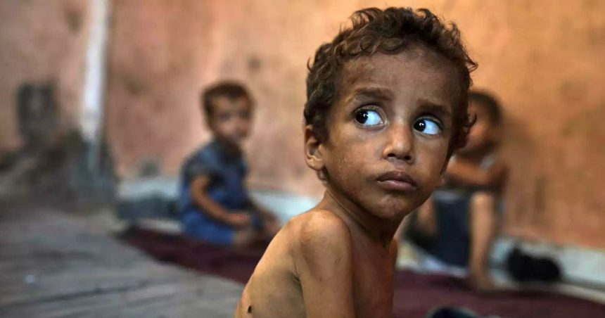 Unicef | 12 000 enfants gravement malnutris à Gaza