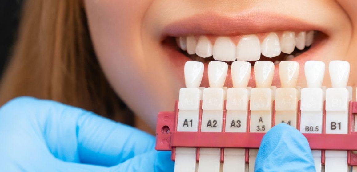 Non au blanchiment dentaire en dehors des cabinets médicaux