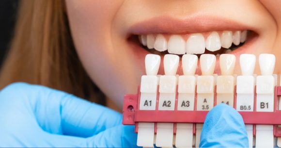 Non au blanchiment dentaire en dehors des cabinets médicaux